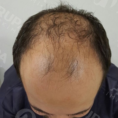 5000 Grafts Hair Transplant Cost Results More ClinicAdvisor