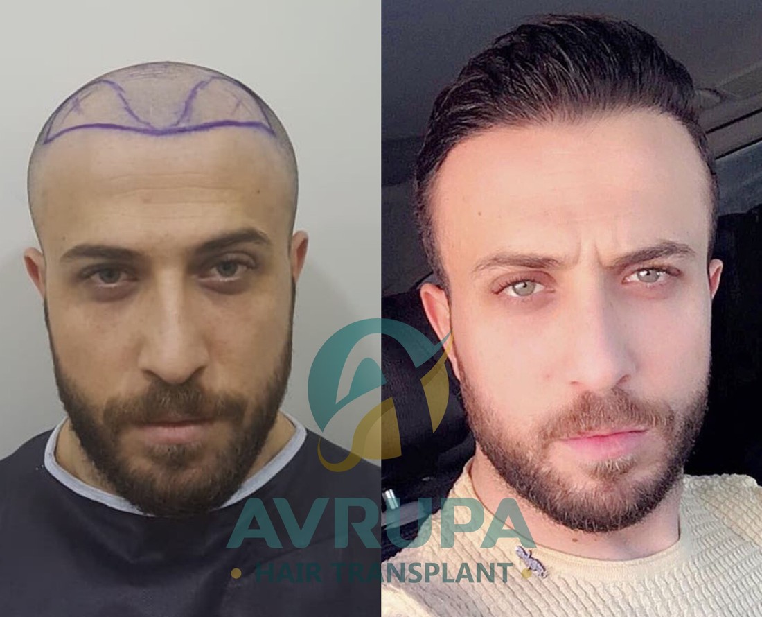 Hair Transplant Results : 15 real cases by clinic AvrupaHairTransplant ...