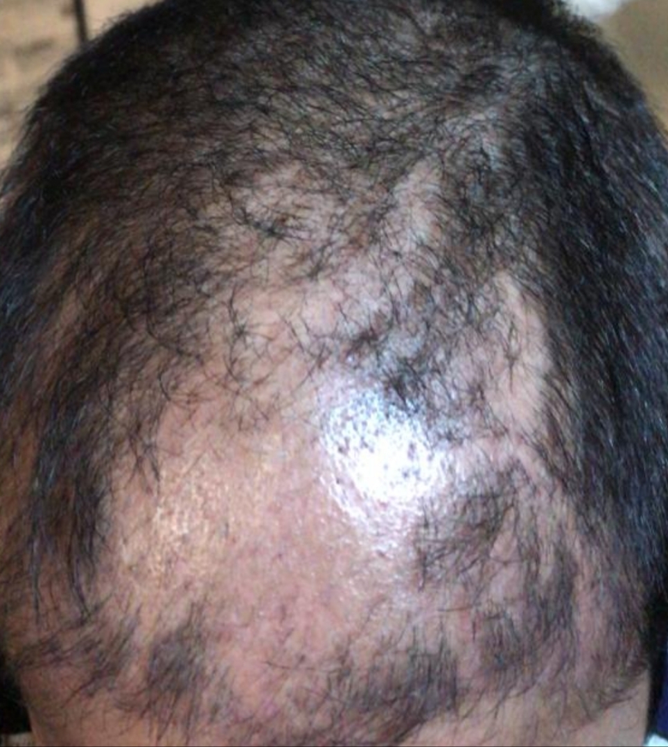 Hair falling out  Shedding after hair transplant NYC