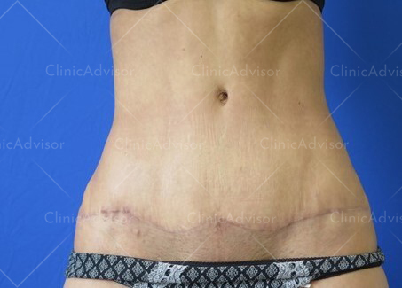 What Kind of Scar Can You Expect After a Tummy Tuck?