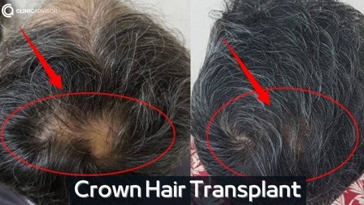 Crown Hair Transplant Procedure Recovery  Success Rate  Longevita